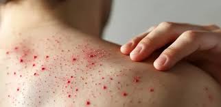 Sarampión bajo control en Tabasco: reportan dos casos fuera de peligro y vacunación supera el 90%